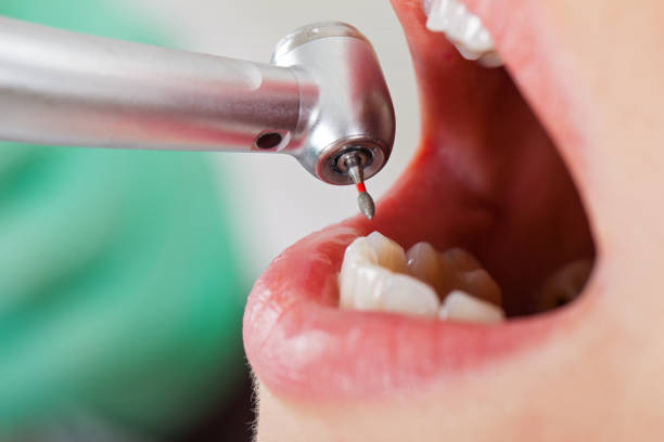 Best Emergency Root Canal Treatment in Great Notch, NJ